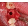 Ustomed NENTWIG, expansores de hueso, talla 1, bayoneta