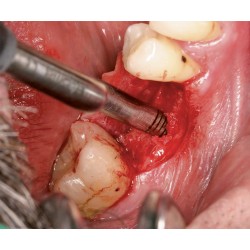 Ustomed NENTWIG, expansores de hueso, tamaño 1, recto