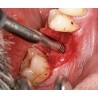 Ustomed NENTWIG, expansores de hueso, tamaño 1, recto