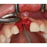 Ustomed NENTWIG, expansores de hueso, tamaño 1, recto