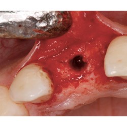Ustomed NENTWIG, expansores de hueso, tamaño 1, recto