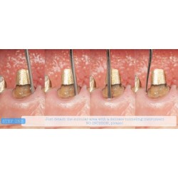 INSTRUMENTO TUNELIZACION DR. RICARDO KERN FIGURA 1 MANGO NARANJA PEEK