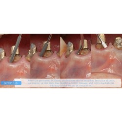 INSTRUMENTO TUNELIZACION DR. RICARDO KERN FIGURA 1 MANGO NARANJA PEEK