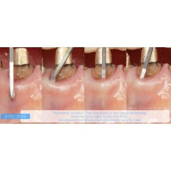 INSTRUMENTO TUNELIZACION DR. RICARDO KERN FIGURA 1 MANGO NARANJA PEEK