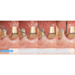 INSTRUMENTO TUNELIZACION DR. RICARDO KERN FIGURA 2 MANGO NARANJA PEEK