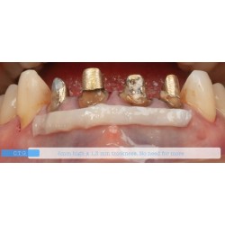 INSTRUMENTO TUNELIZACION DR. RICARDO KERN FIGURA 2 MANGO NARANJA PEEK