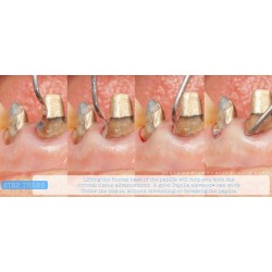 INSTRUMENTO TUNELIZACION DR. RICARDO KERN FIGURA 3 MANGO NARANJA PEEK