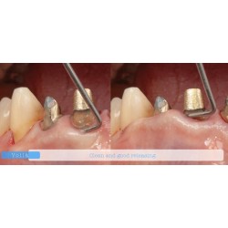 INSTRUMENTO TUNELIZACION DR. RICARDO KERN FIGURA 4 MANGO NARANJA PEEK