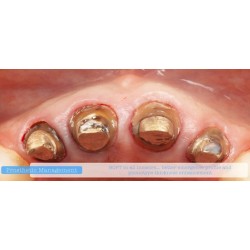 INSTRUMENTO LIBERADOR MUSCULAR DR. RICARDO KERN MANGO NARANJA PEEK